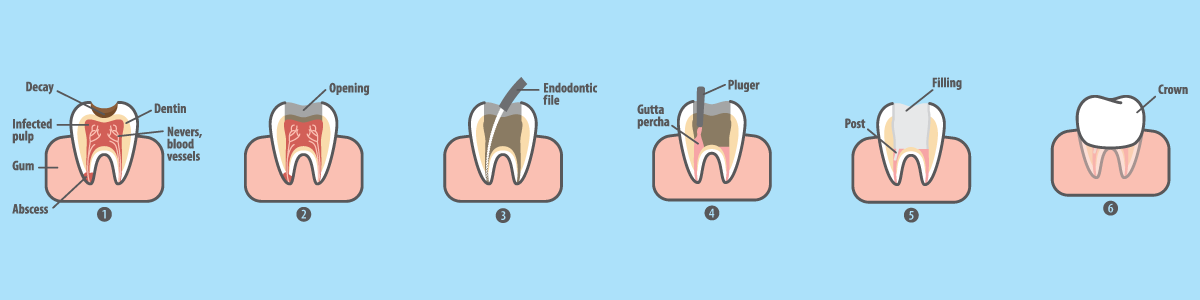 Root Canal Therapy Illustration