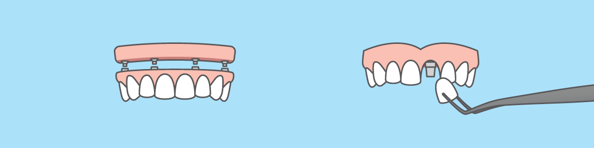 Vector Image Dental Implants Illustration