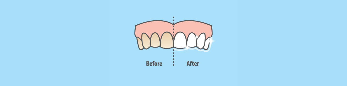 Vector Image Teeth Whitening