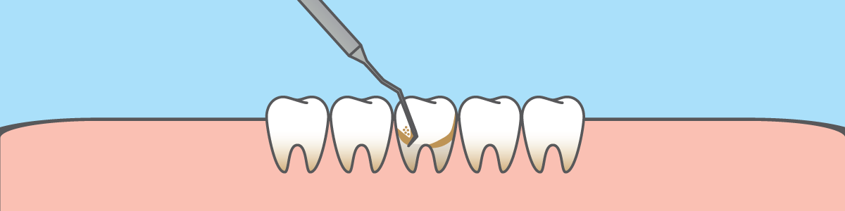 Vector of Teeth Cleaning